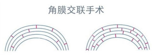 角膜交联手术