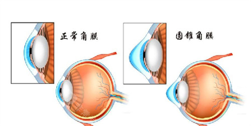 圆锥角膜和正常角膜的区别是什么