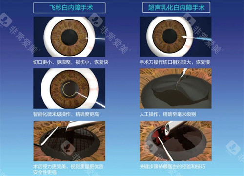 深度解析！光明眼科做白内障技术如何？附收费价格表