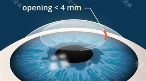 兰大二院眼科近视手术价格，全飞秒、全激光、ICL晶体植入等价格
