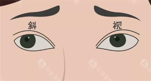 斜视眼珠表现图
