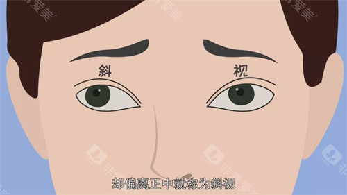 斜视动画示意图