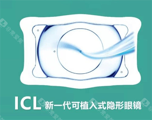 ICL晶体植入