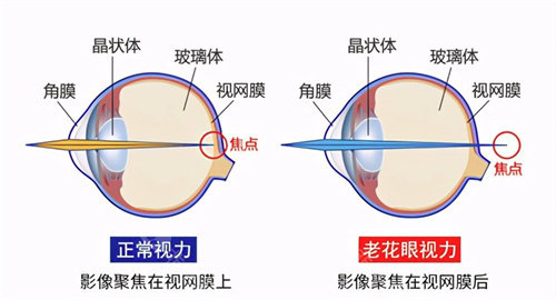 老花眼和正常视力