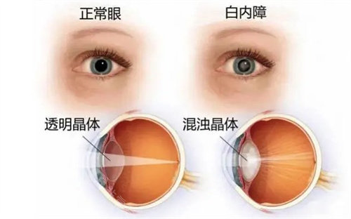 正常眼白内障的区别