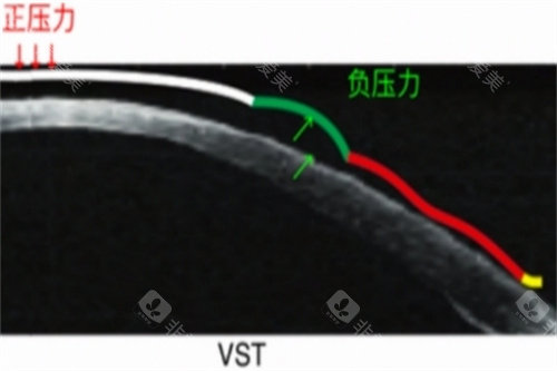 VST角膜塑形镜力的示意图
