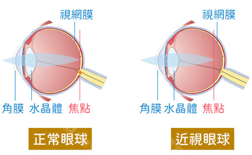 正常眼球和近视眼球的区别图解