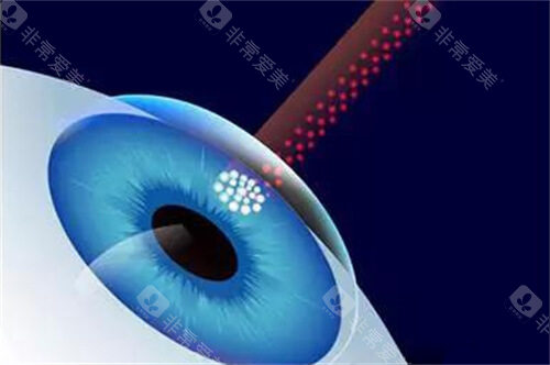 露晰得LucidRGP眼镜实测：矫正散光比框架镜狠，4000-6000元花得值吗？