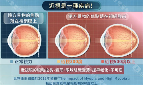 不同程度近视的眼球变化图解 不同程度近视的眼球变化图解