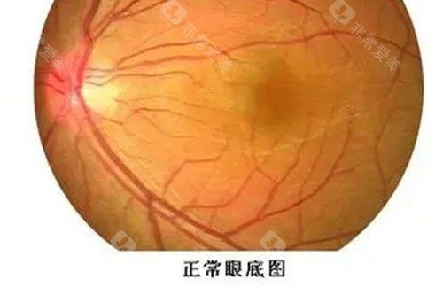 近视眼手术宣传图