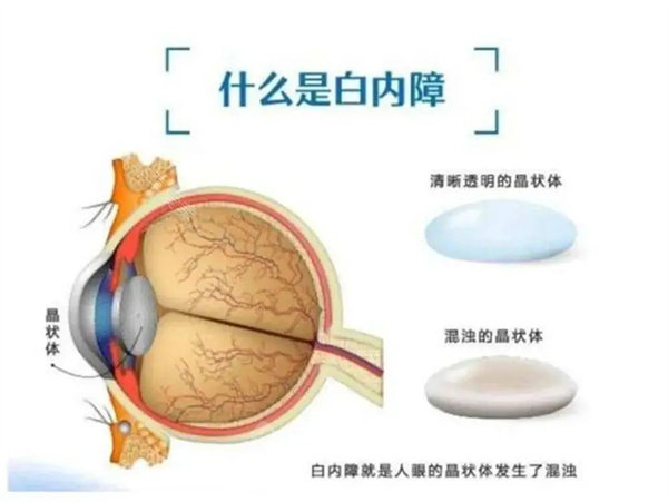 湖北白内障手术费用查询表！可查不同手术方式不同人工晶体详细价格！