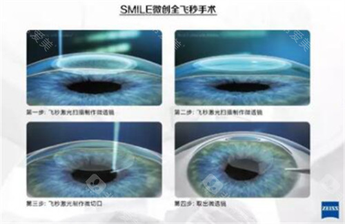 四川省人民医院眼科/华西眼科/爱尔眼科哪个好？术后成果居然都这么惊艳！