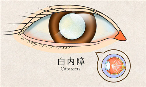 江山白内障手术价格表查询，白内障超声乳化手术5000起/飞秒激光白内障手术10000起！