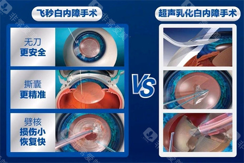 飞秒白内障手术过程