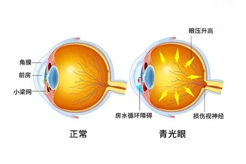 江山青光眼手术多少钱，激光小梁成形术3000起/青光眼引流阀植入术10000起！