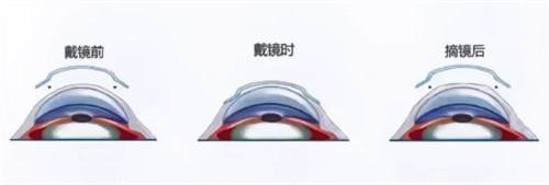 角膜塑形镜佩戴