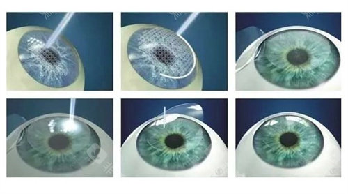 荆州做近视眼飞秒多少钱？2025年荆州近视详细价格表！