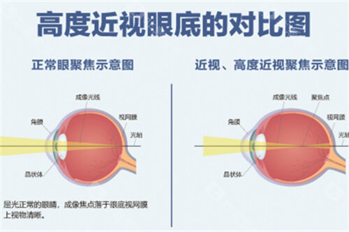 高度近视眼底的对比图