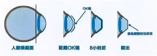 角膜塑形镜8小时后变化