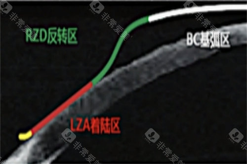 CRT角膜塑形镜作用示意图