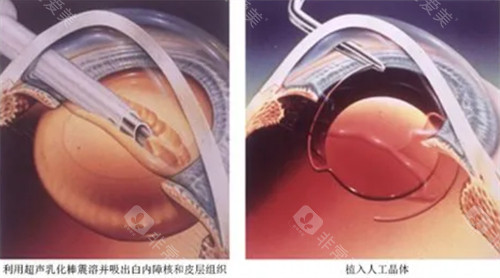 超声乳化白内障