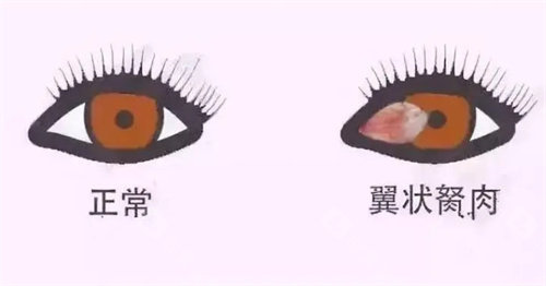 翼状胬肉