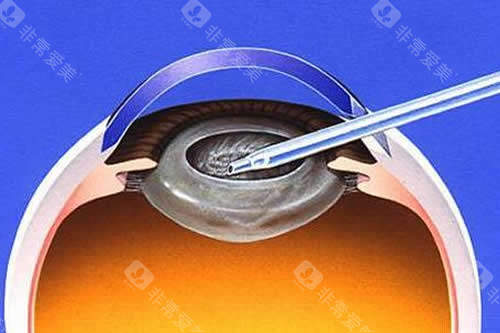 2025台州白内障手术免费政策新规，受益人群/免费范围/申请流程等查看！