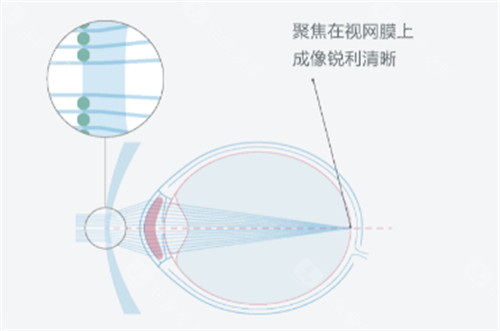 周边离焦技术镜片都有什么?盘点:蔡司成长乐、依视路星趣控等主流产品全解析!