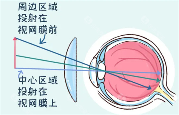 离焦软镜矫正原理图解