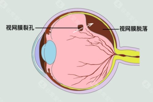 视网膜脱落卡通图