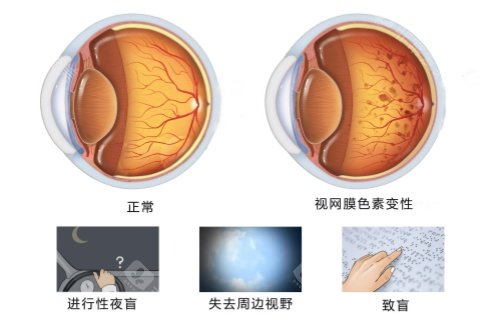 视网膜色素变性症状图