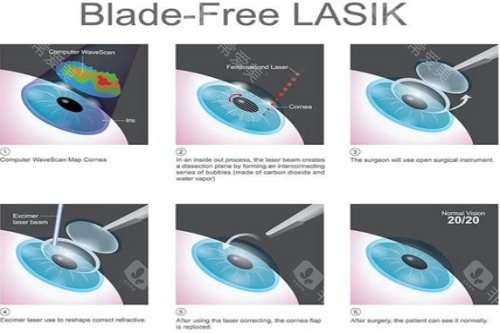 LASIK手术