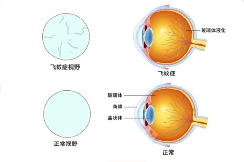台州治疗飞蚊症哪家好，台州爱尔眼科/台州华厦眼科口碑技术好！