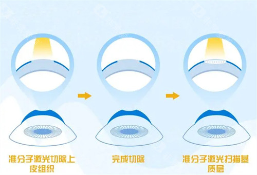 不同的近视手术