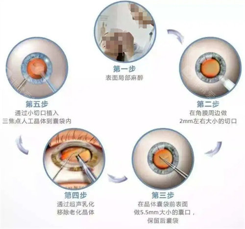 白内障手术大连哪家医院好？白内障认准这三家医院大家尽管放心！
