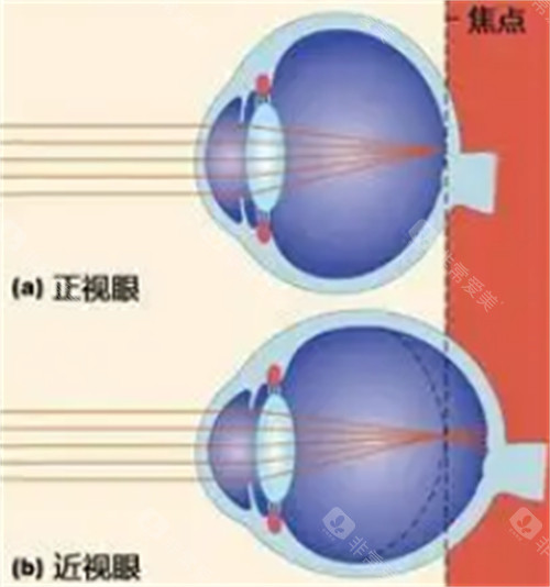 正常眼睛和近视眼镜的不同