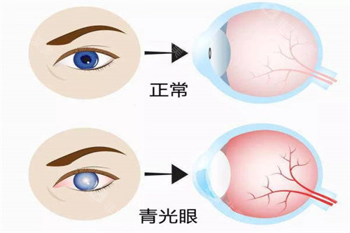 邢台眼科医院青光眼手术多少钱?为啥好多人都去约吕建华医生手术?