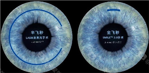 宁夏医大医院眼科收费标准！近视手术、白内障等项目价格全解析！