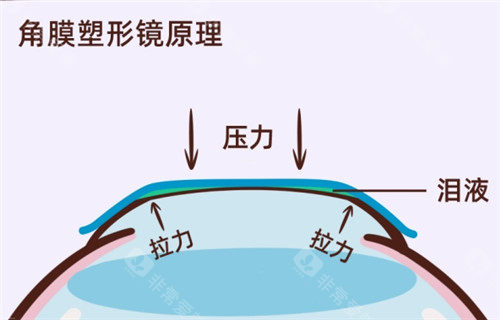 角膜塑形镜原理过程