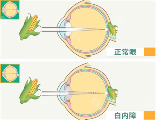 差点错过减免！克拉玛依白内障手术政策申请全流程，附收费对比表