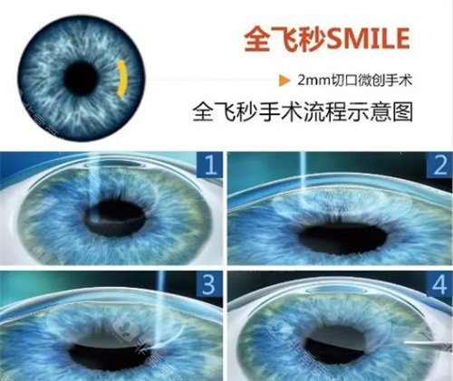 武汉普瑞眼科医院近视手术价格表2025年新版整理！各类型手术价格都有调整！