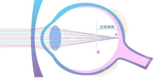 近视戴离焦镜片好吗？这3类人必选！附离焦镜vs普通镜5大差异表