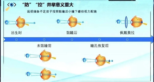 近视戴离焦镜片有效吗？眼科数据：比普通镜片延缓近视60%