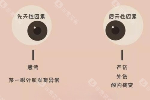 眼睛斜视产生原因卡通图片