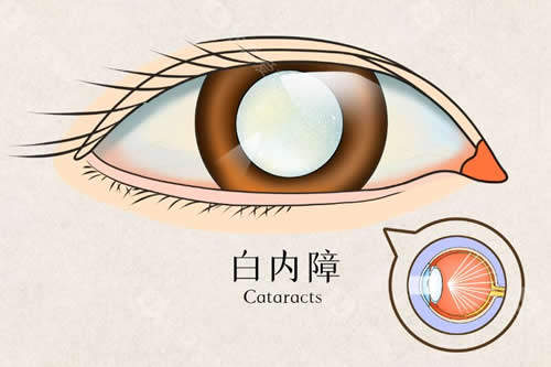 飞秒激光辅助白内障手术优势，精细度高/术后改善快/适应范围广/个性化手术方案！