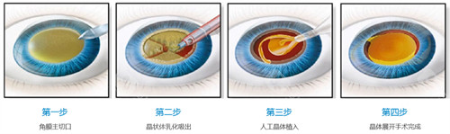 飞秒激光辅助白内障手术价格查看，基础手术费用15000~20000元不等！