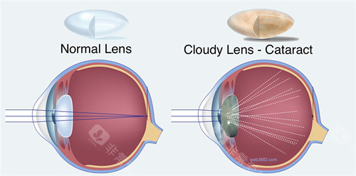 2025更新！喀什眼科项目收费价格表曝光： cataract手术价目与验光费用差这么多？
