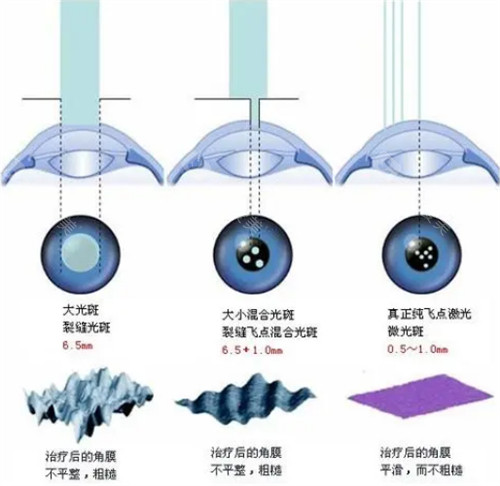 近视手术对比