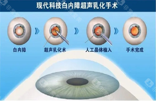 琼海白内障手术价格表查看，白内障超声乳化4310元起/飞秒激光白内障手术10603元起！