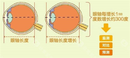 眼轴长度与近视